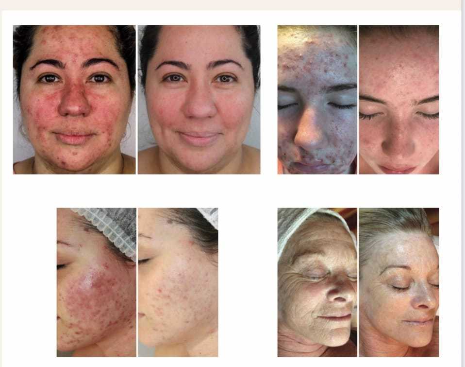 Before and after skincare results showing improvements in facial skin conditions.